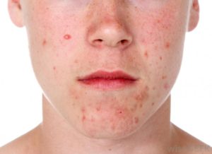 Acne treatment Cheltenham